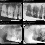 Tratament endodontic dintele 1.6-CabinetStomatologicAdedent