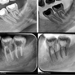 Tratament endodontic dintii 3.7, 3.8-CabinetStomatologicAdedent