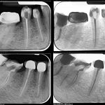 Tratament endodontic dintele 4.7-CabinetStomatologicAdedent