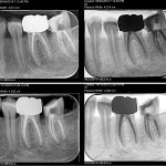 Retratament endodontic dintii 3.6, 3.7-CabinetStomatologicAdedent