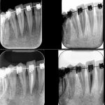 Tratament endodontic dintele 4.3-CabinetStomatologicAdedent