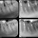 Tratament endodontic dintele 3.7-CabinetStomatologicAdedent