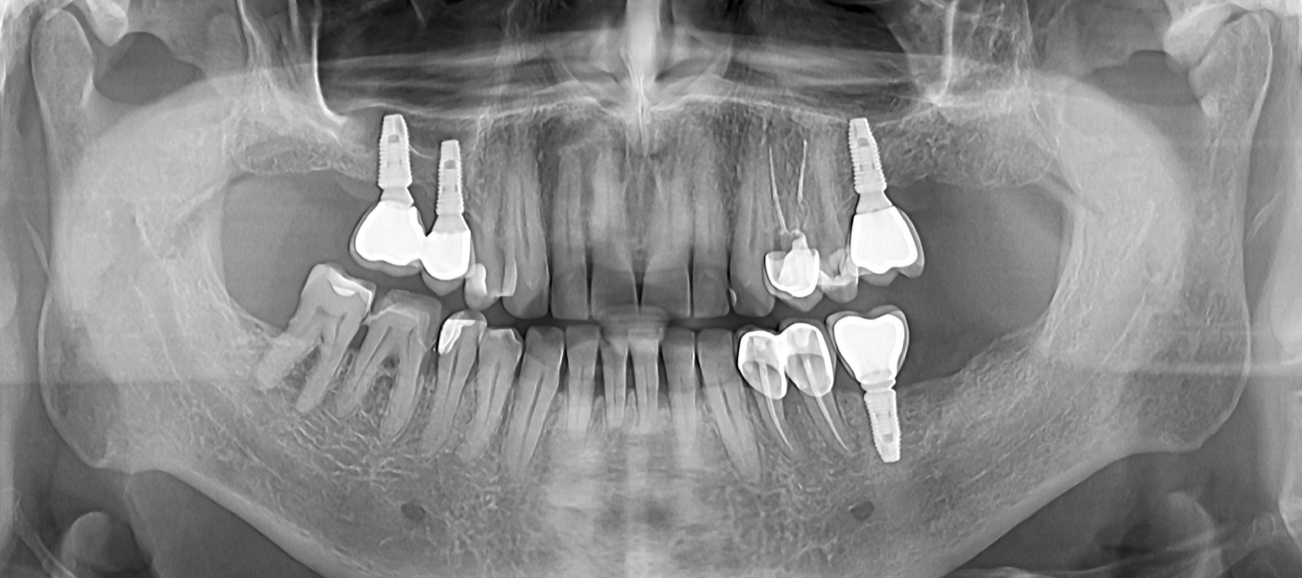 Implanturi dentare- spatiu 1.5, 1.6, 2.6, 3.6-CabinetStomatologicAdedent