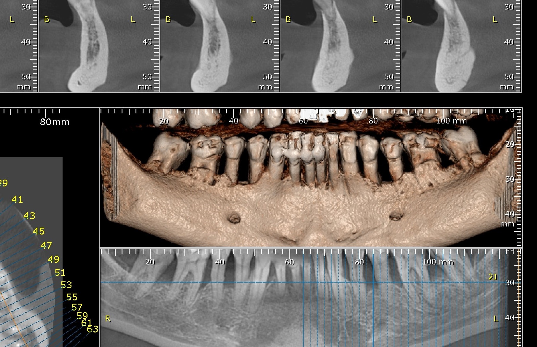 Radiografie tridimensionala- Boala parodontala(Parodontoza)-CabinetStomatologicAdedent