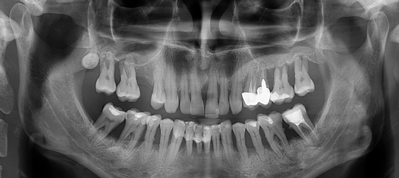 Radiografie panoramica- aspect 2D Boala parodontala(Parodontoza)-CabinetStomatologicAdedent
