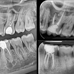 Retratament endodontic dintii 2.6, 3.6-CabinetStomatologicAdedent