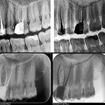 Retratament endodontic dintele 2.6-CabinetStomatologicAdedent