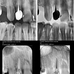 Retratament endodontic 1.2, indepartare coroana si DCR-CabinetStomatologicAdedent