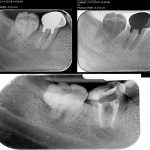 Retratament endodontic 4.7, indepartare coroana si DCR-CabinetStomatologicAdedent